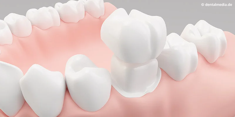 Metal-free crown - completely consisting of high-performance ceramics