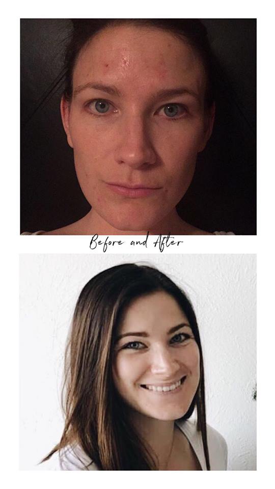 before and after acne.jpg