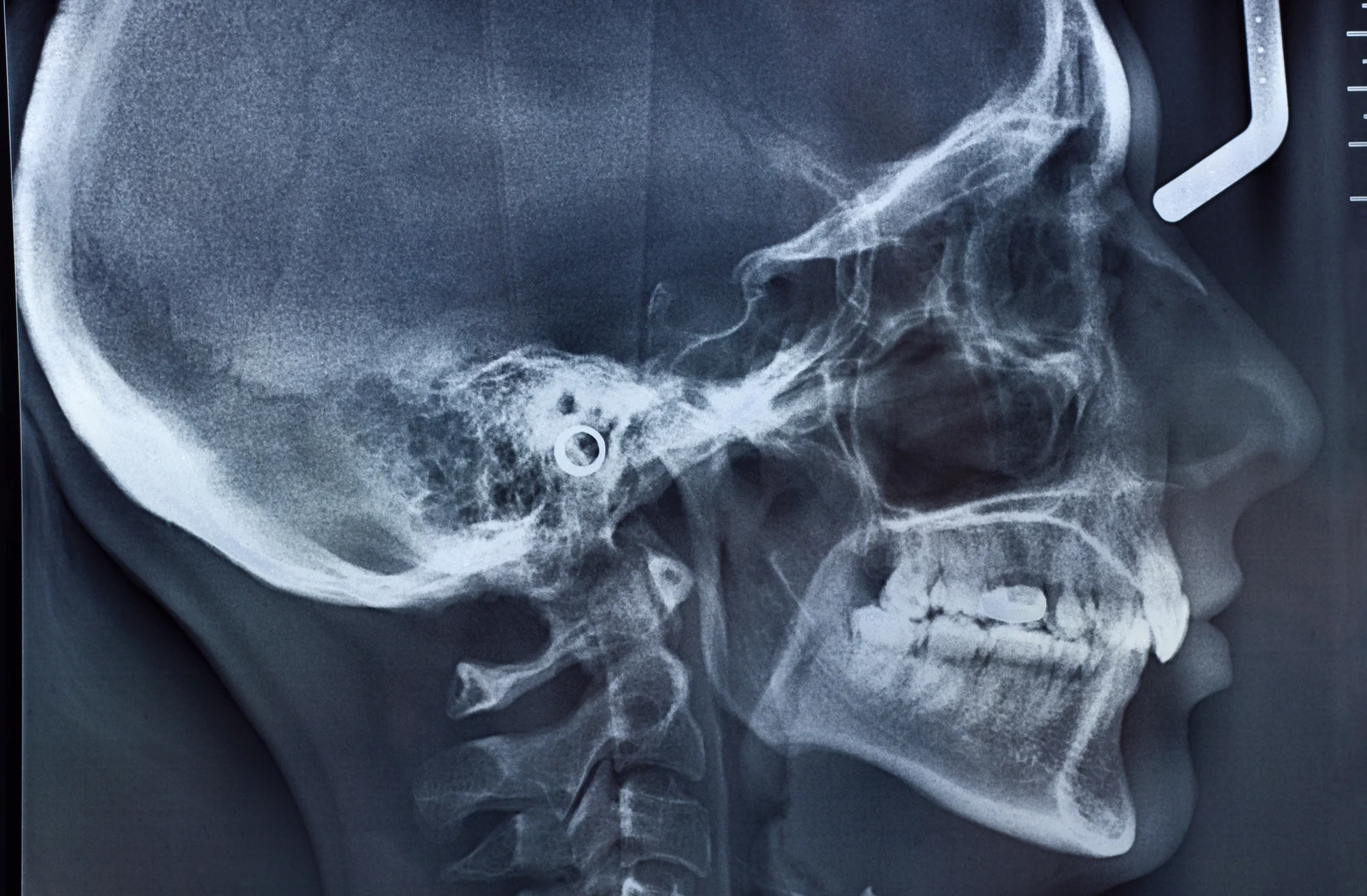 You must have an order from a doctor, nurse practitioner, physicians assistant or chiropractor to obtain an x-ray.    No appointment necessary.     There are no preparations for this exam. Please remove jewelry that may be in the area of study