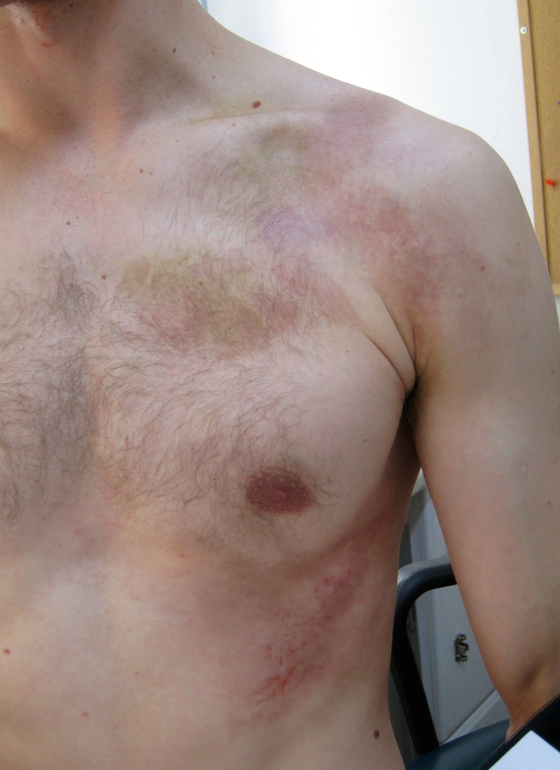 Greg Smith- Rookie Blue- Aged Contusions