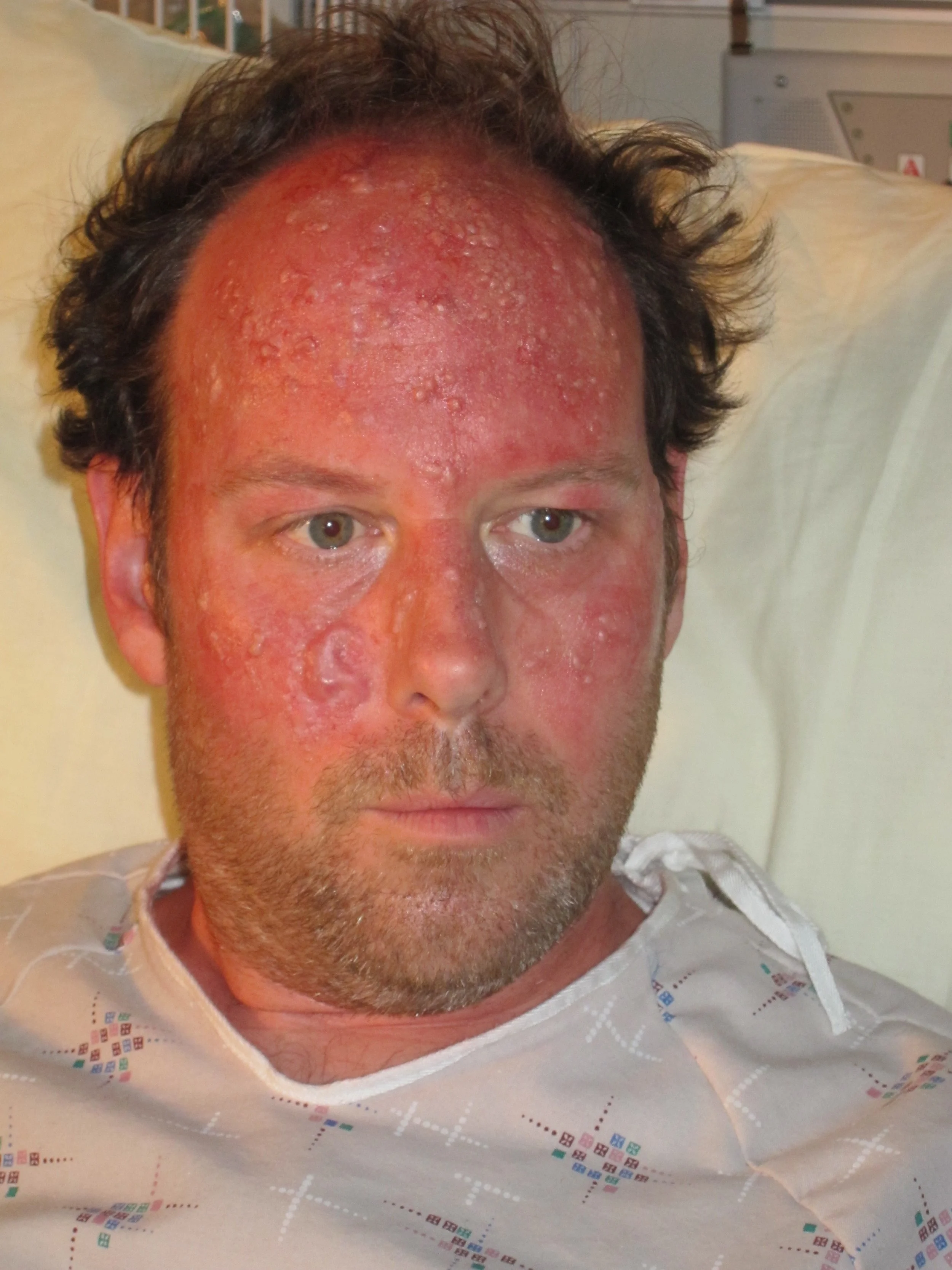 Matt Gordon- Saving Hope - Polymorphous Light Eruption