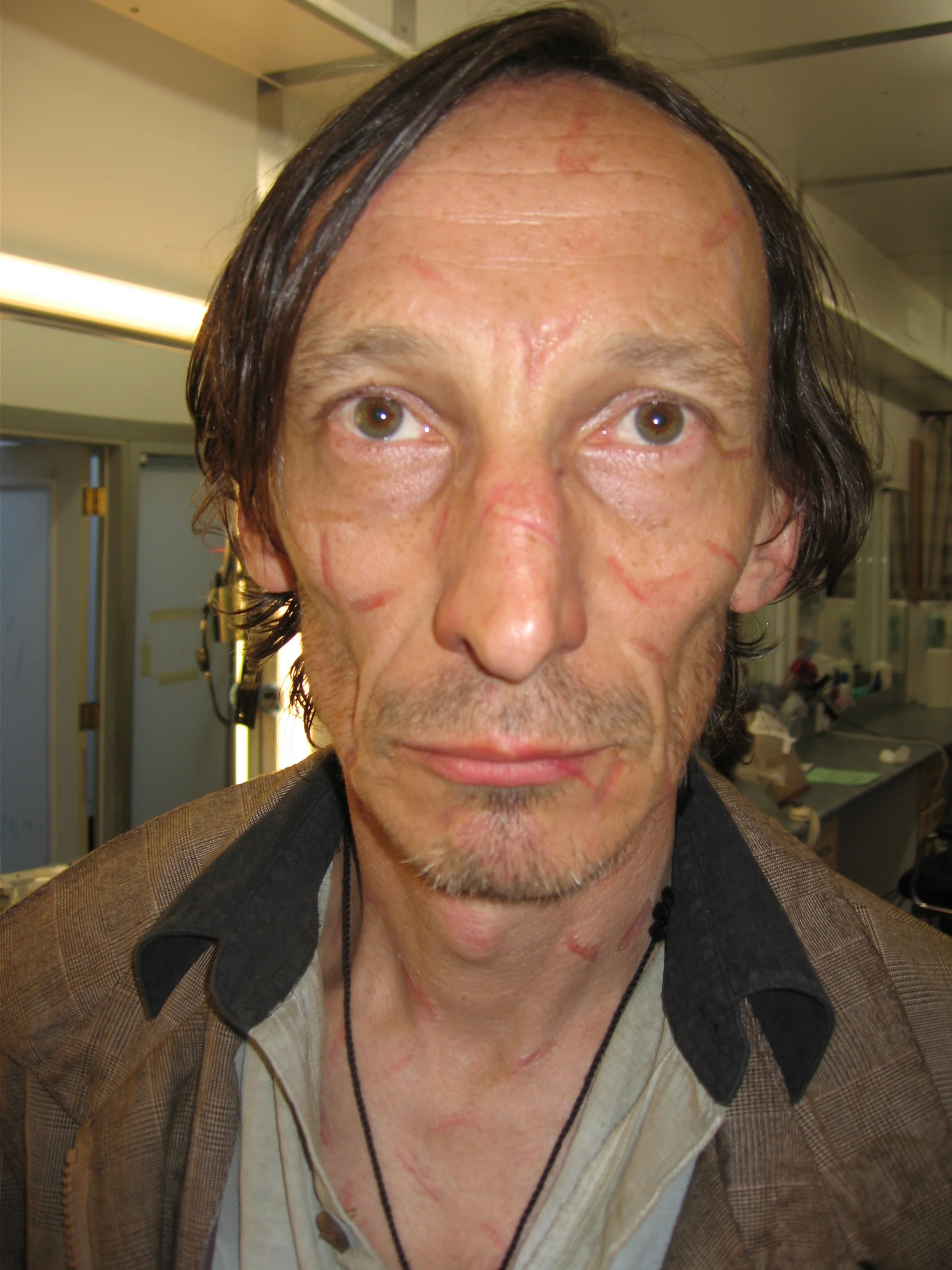Julian Richings- Saw IV-Atrophic Scarring