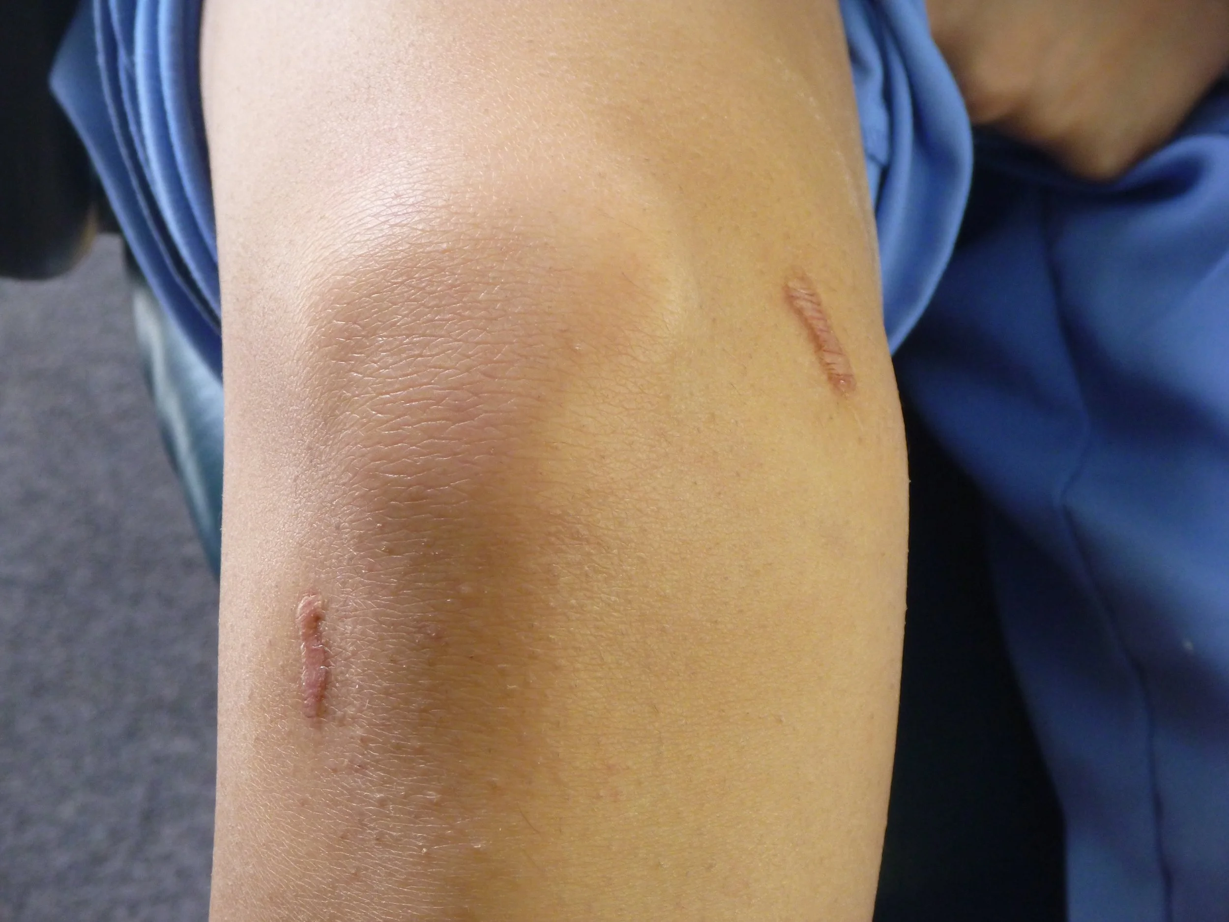 Saving Hope- Laparoscopic Surgery Scars