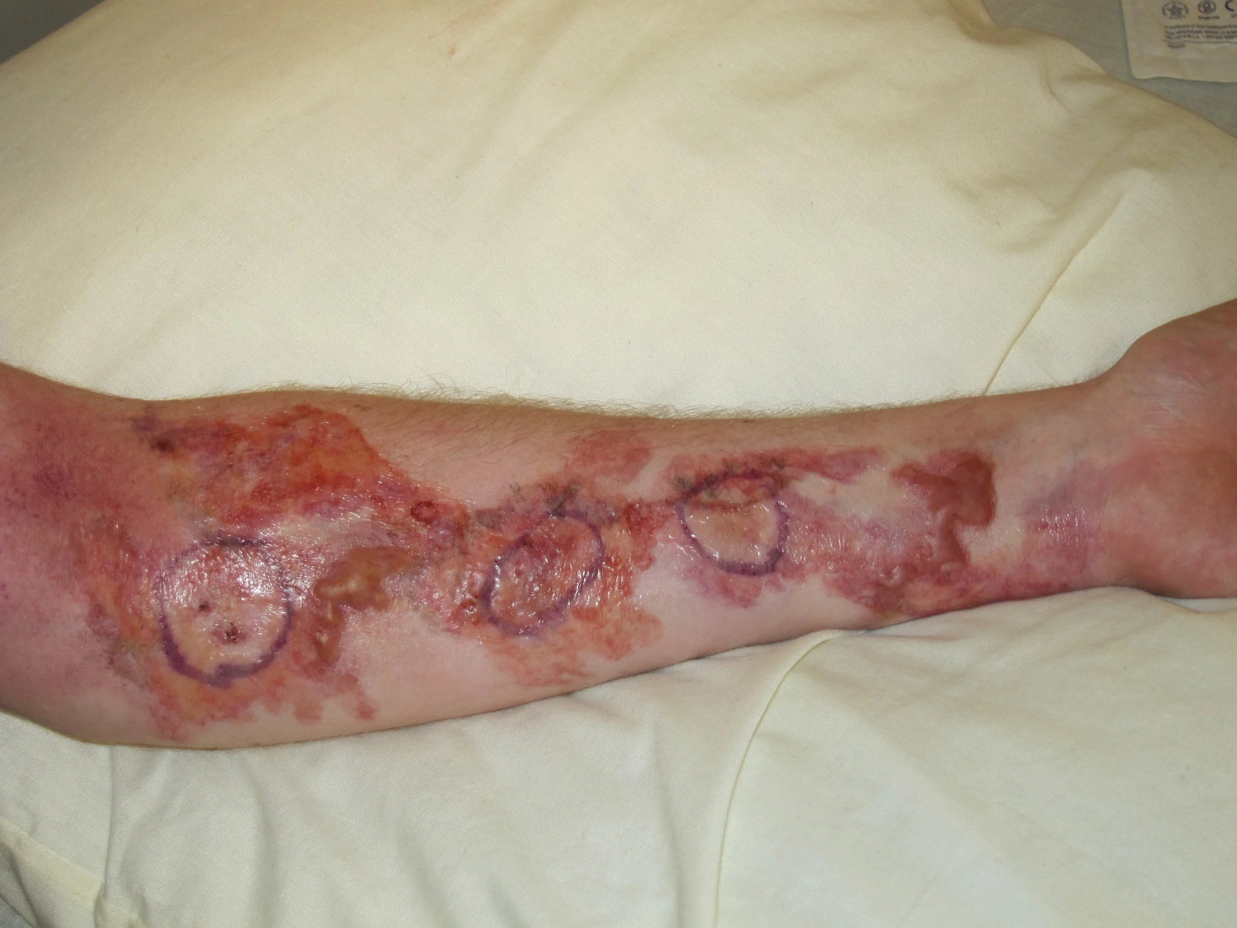 Saving Hope- Necrotizing Fasciitis