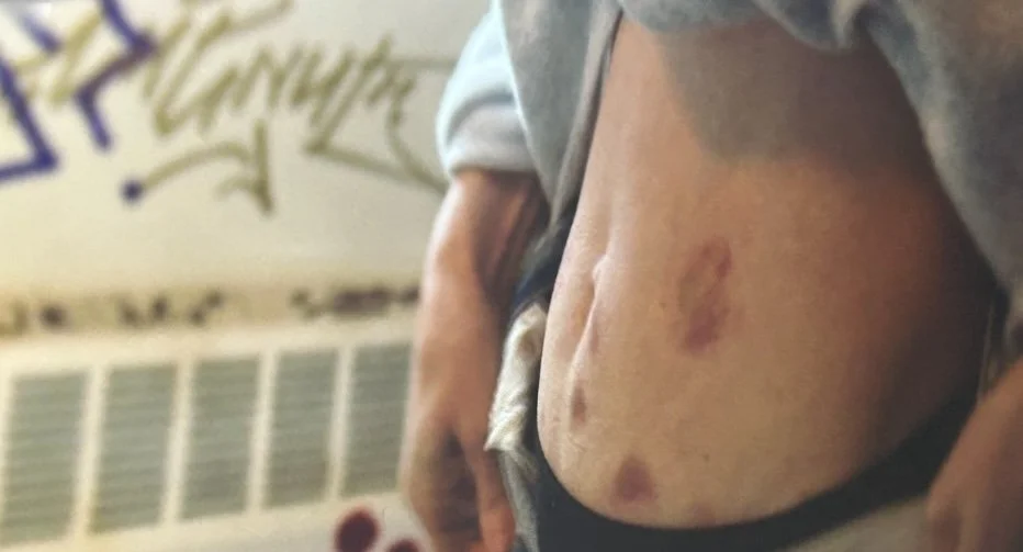 Sisters Season 2- IVF Bruising