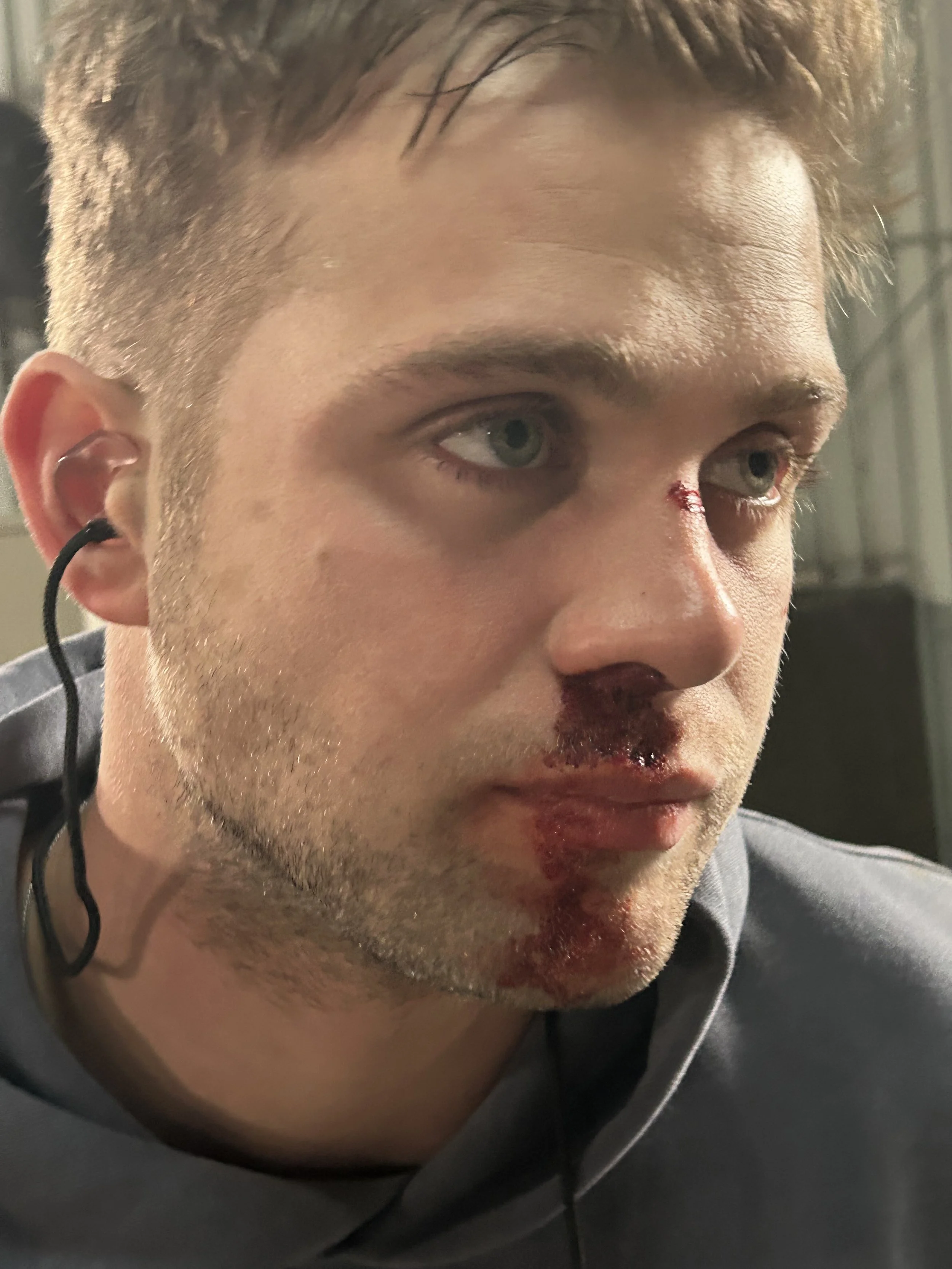 Leo Woodall-Tuner- Broken Nose/Nose Bleed