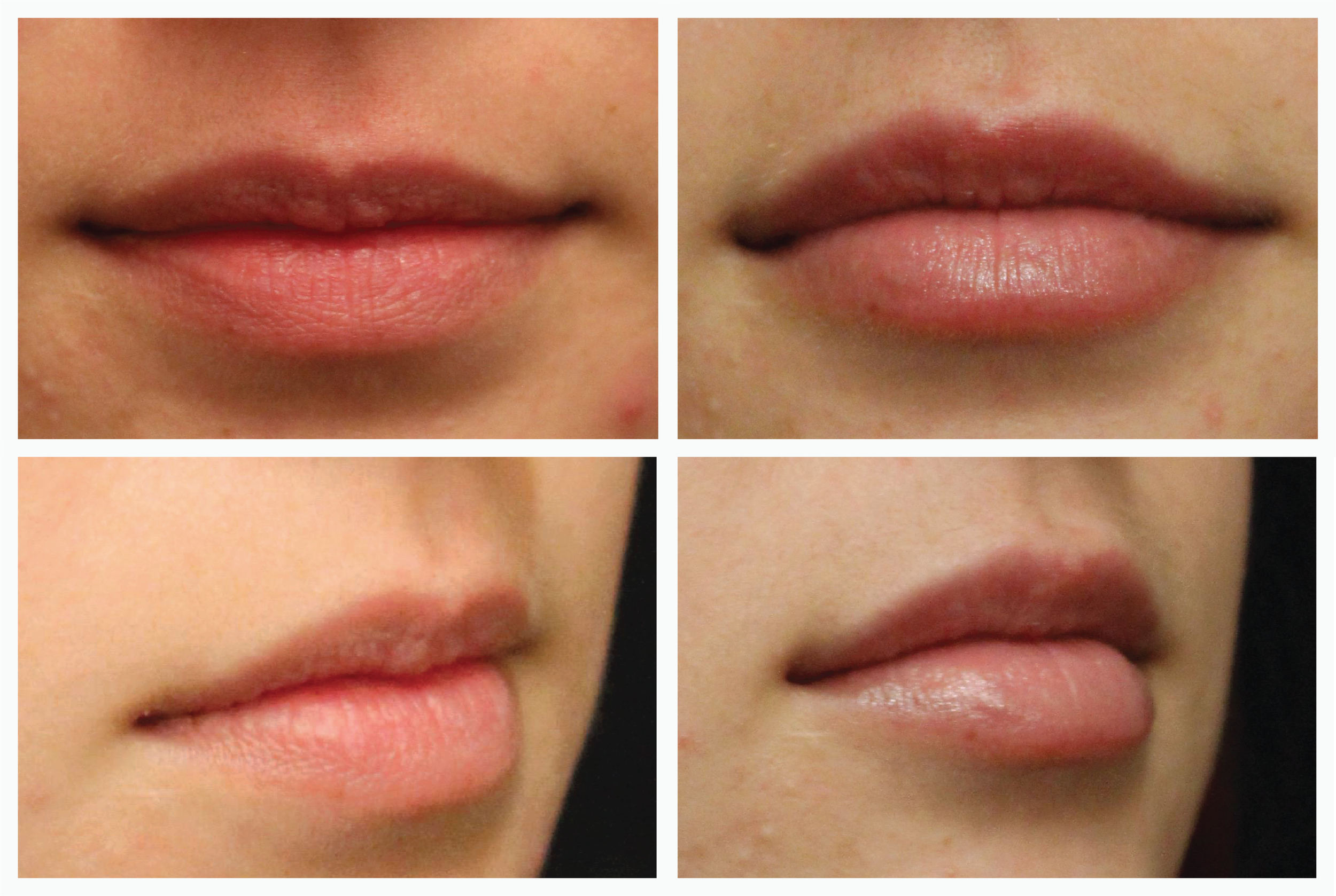 hyaluronic acid lip filler after care