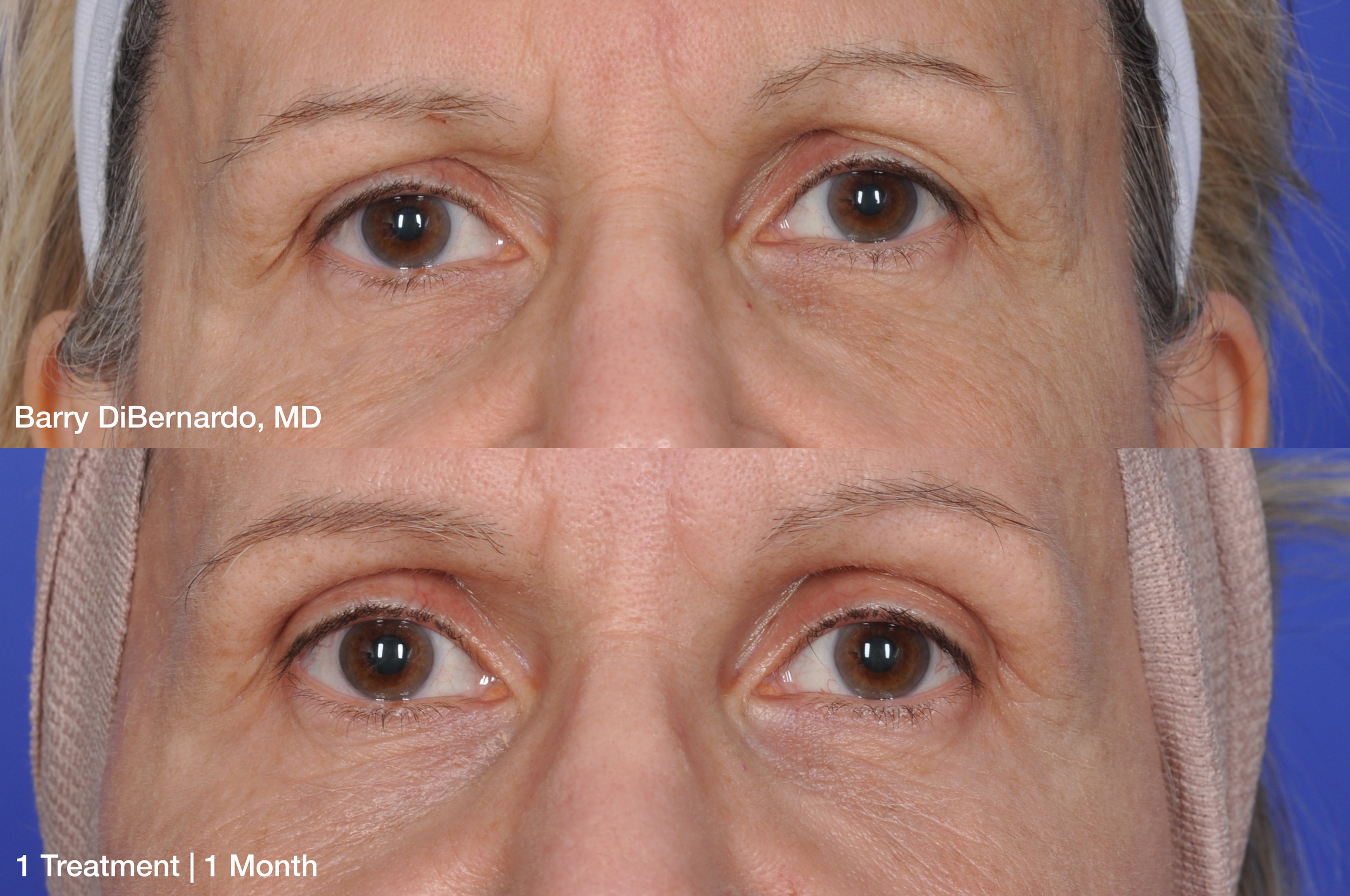 Barry-DiBernardo_ThermiSmooth-Face-Eyes_1-treatment-1-Month_Patient-1.jpg