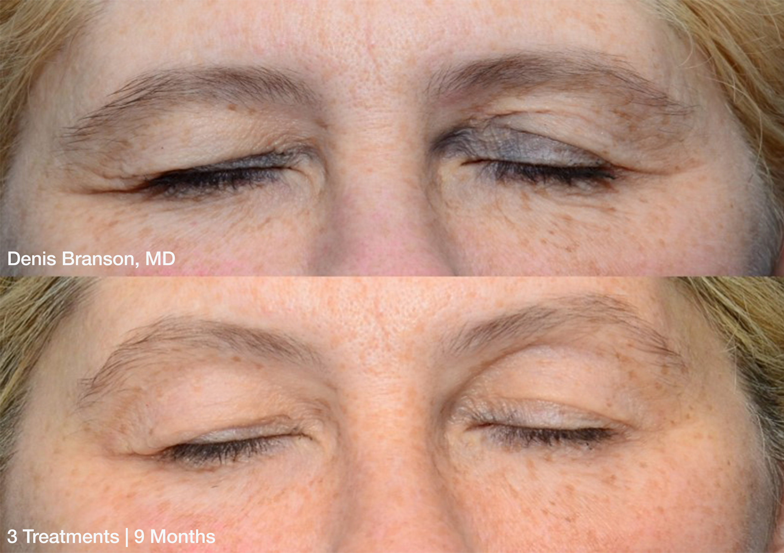 Denis-Branson_ThermiSmooth-Face-Eyes_3-treatments-9-months_Patient-1.jpg