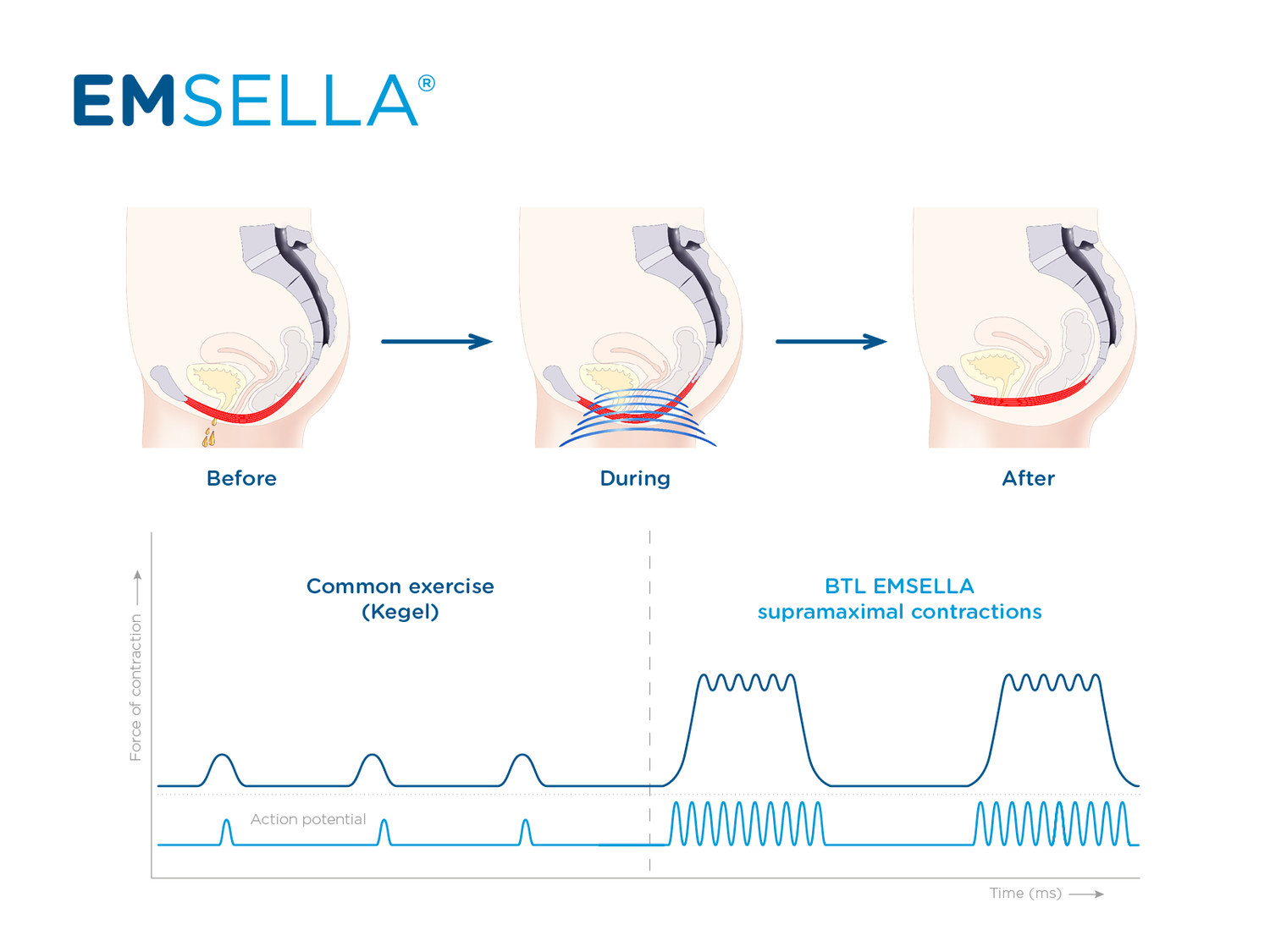Emsella - Urinary Incontinence Treatment — The Retreat Medical Spa