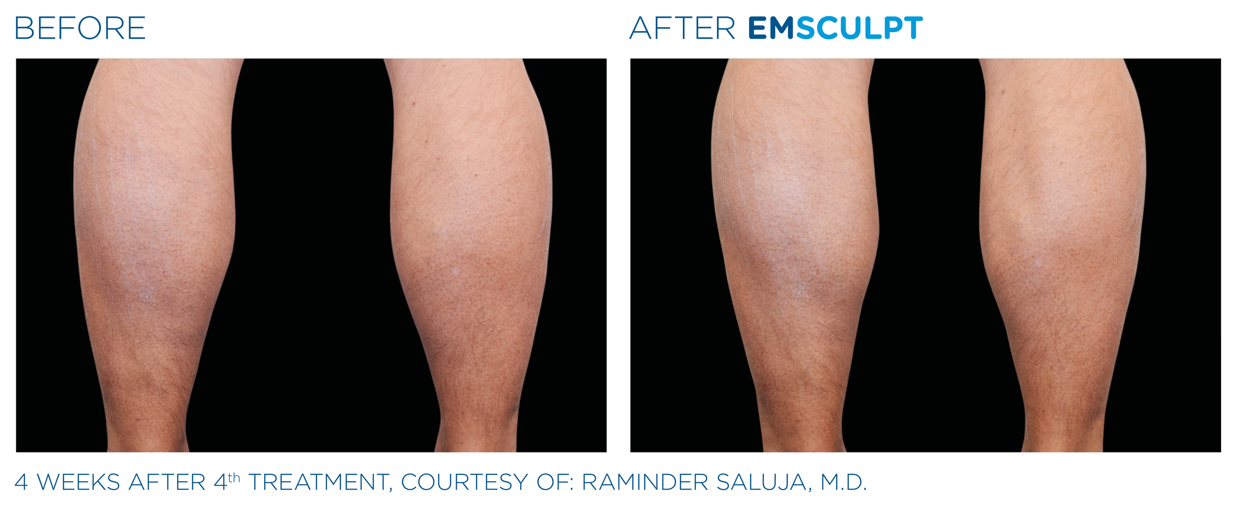 Emsculpt_PIC_Ba-card-male-legs-082_ENUS100.png