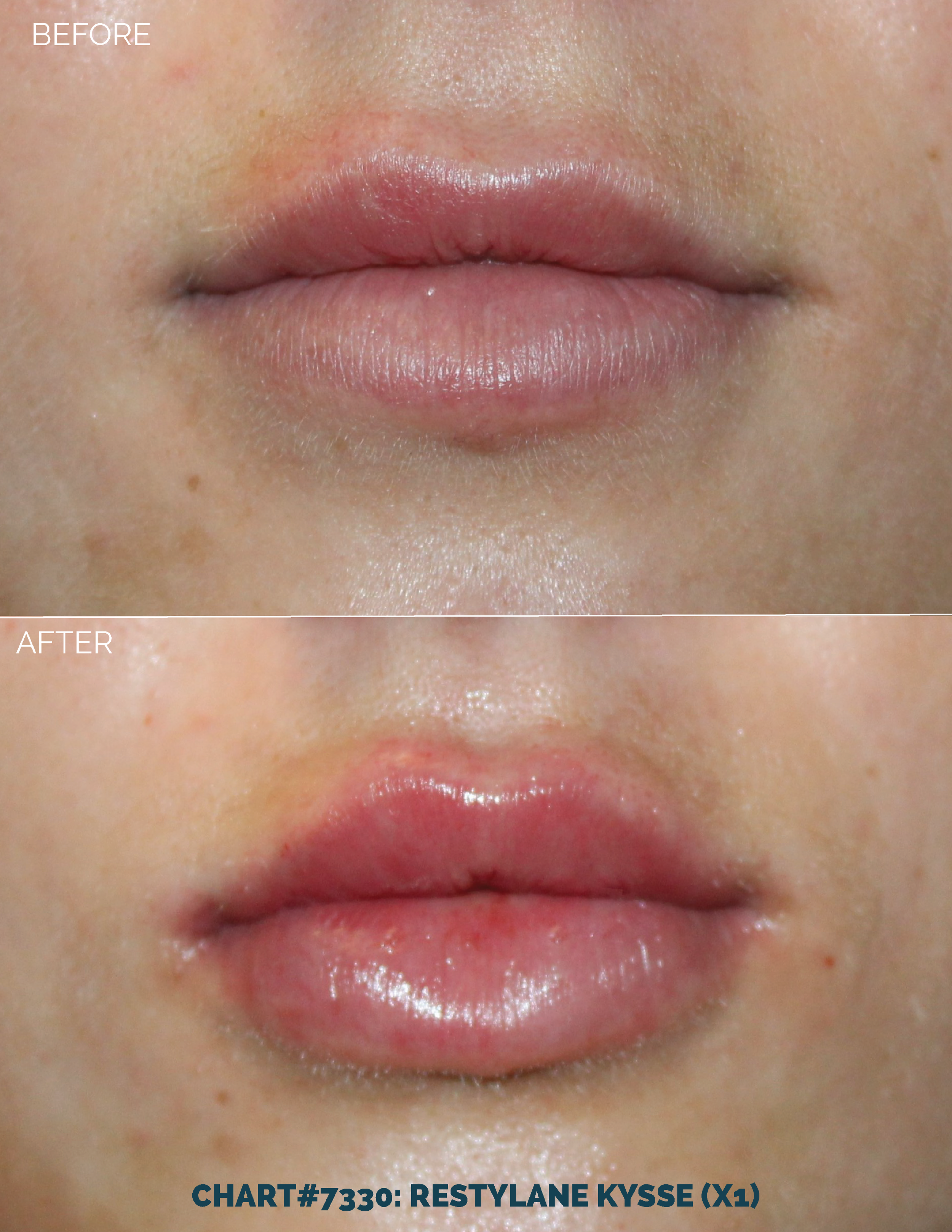 LIPS FILLER_CHART#7330- RESTYLANE KYSSE (X1).png