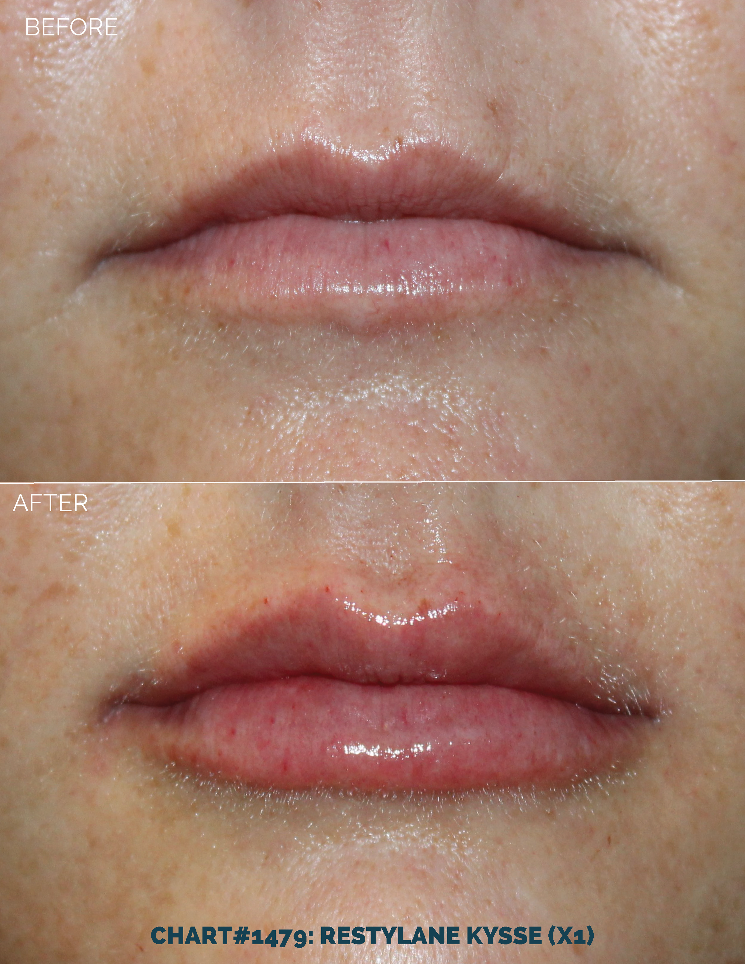 LIPS FILLER_CHART#1479- RESTYLANE KYSSE (X1).png