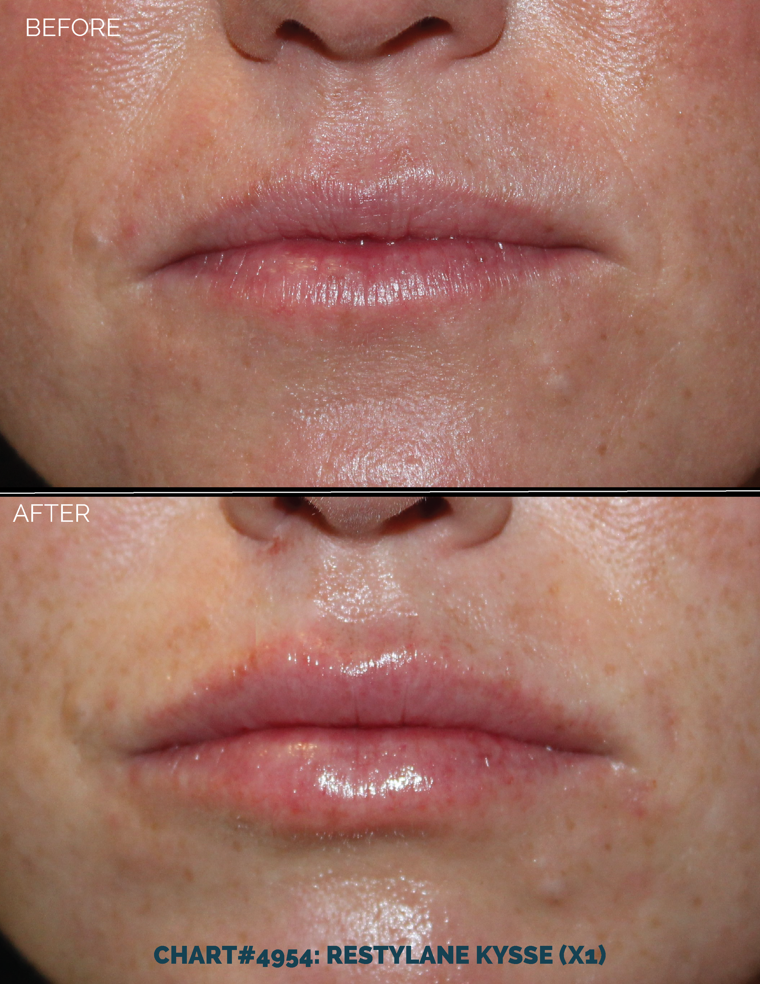 LIPS FILLER_CHART#4954- RESTYLANE KYSSE - 1 SYRINGE.png