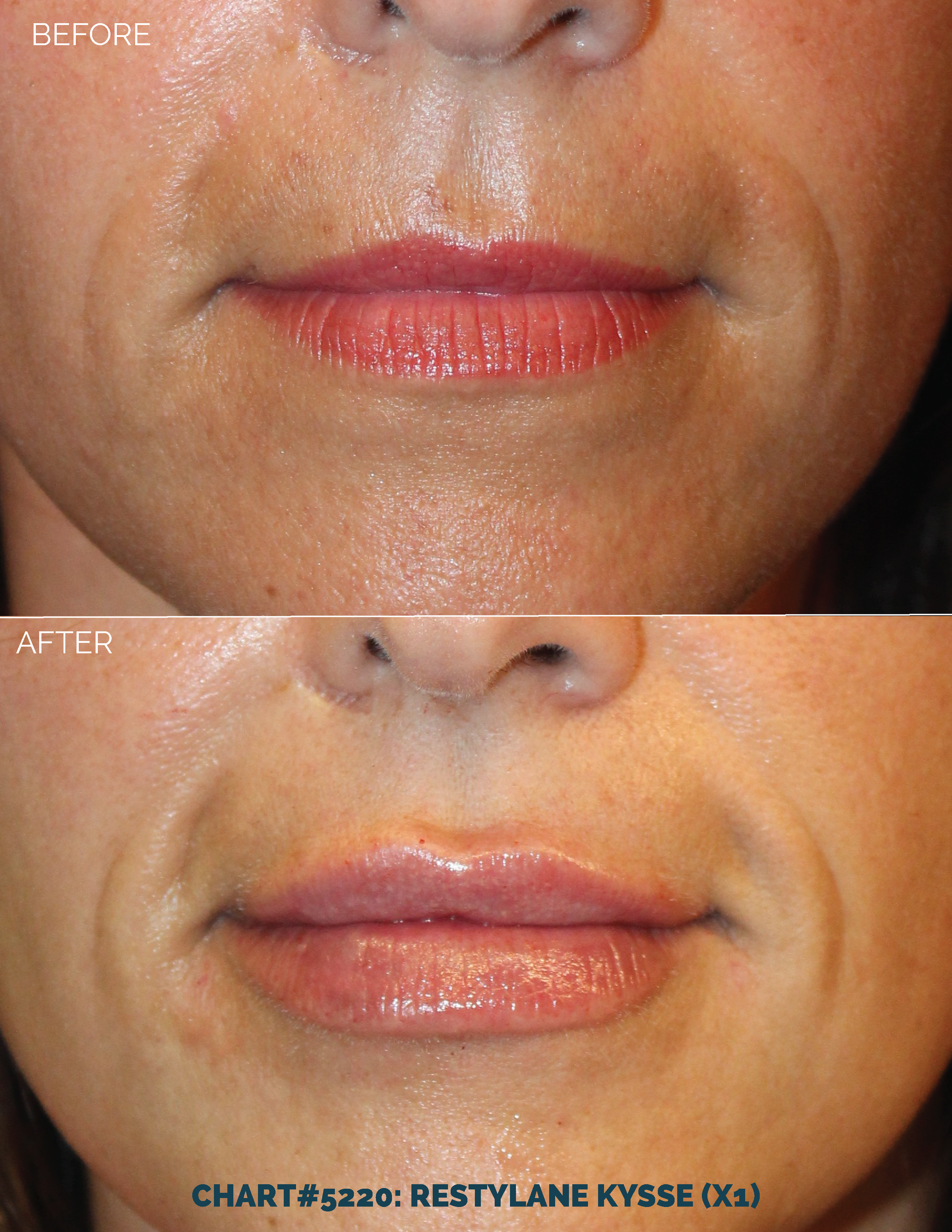 LIPS FILLER_CHART#5220- RESTYLANE KYSSE (X1).png