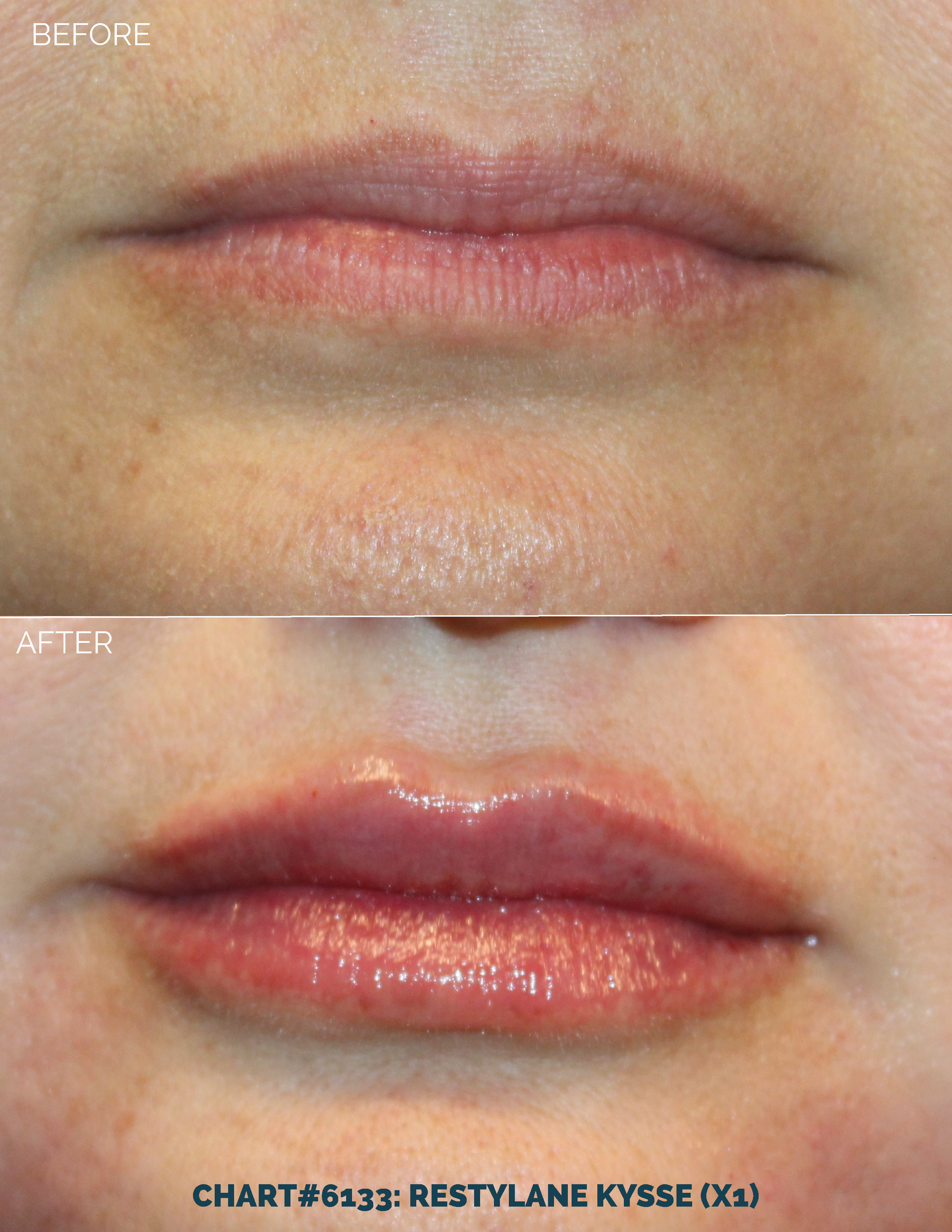 LIPS FILLER_CHART#6133- RESTYLANE KYSSE (X1).png