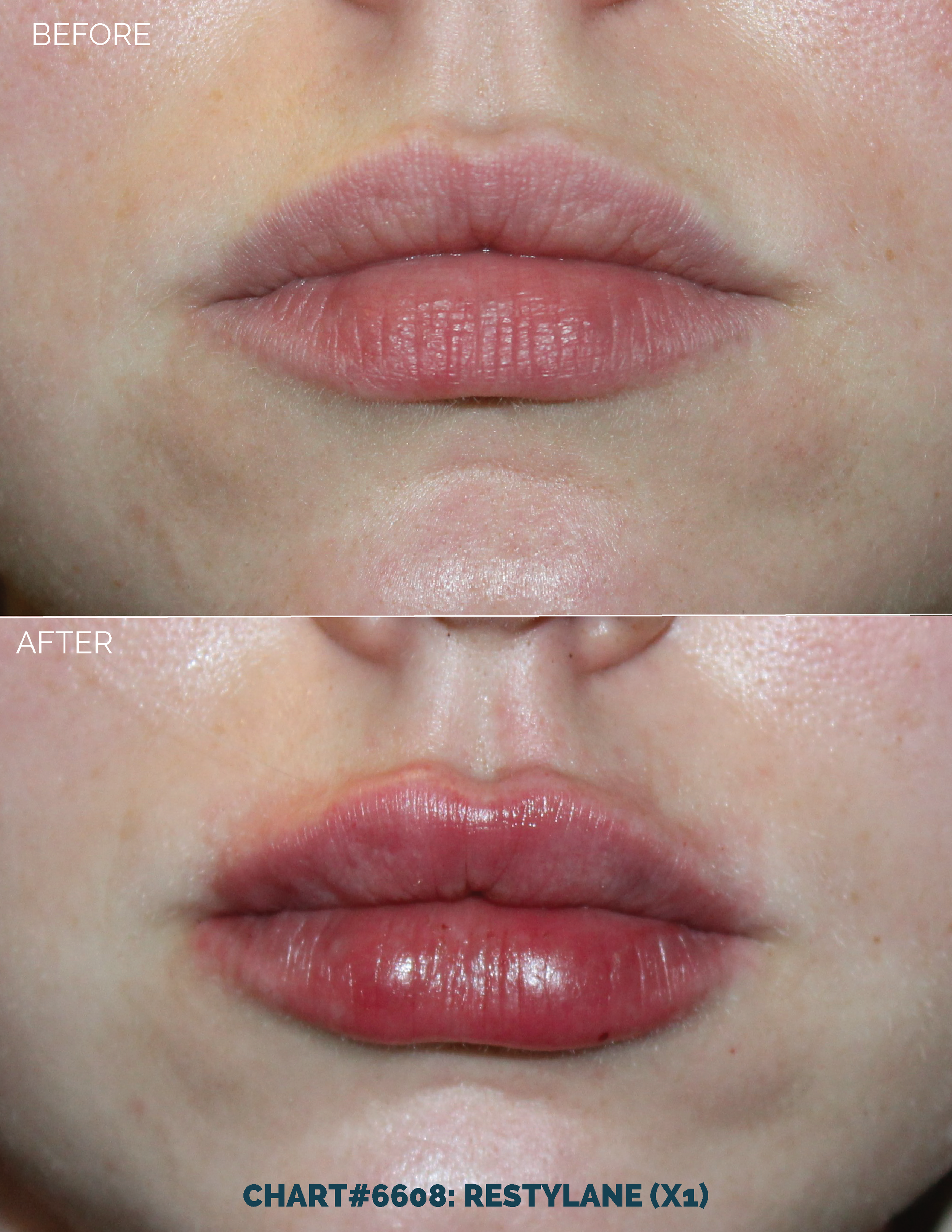 LIPS FILLER_CHART#6636- RESTYLANE (X1) copy 2.png