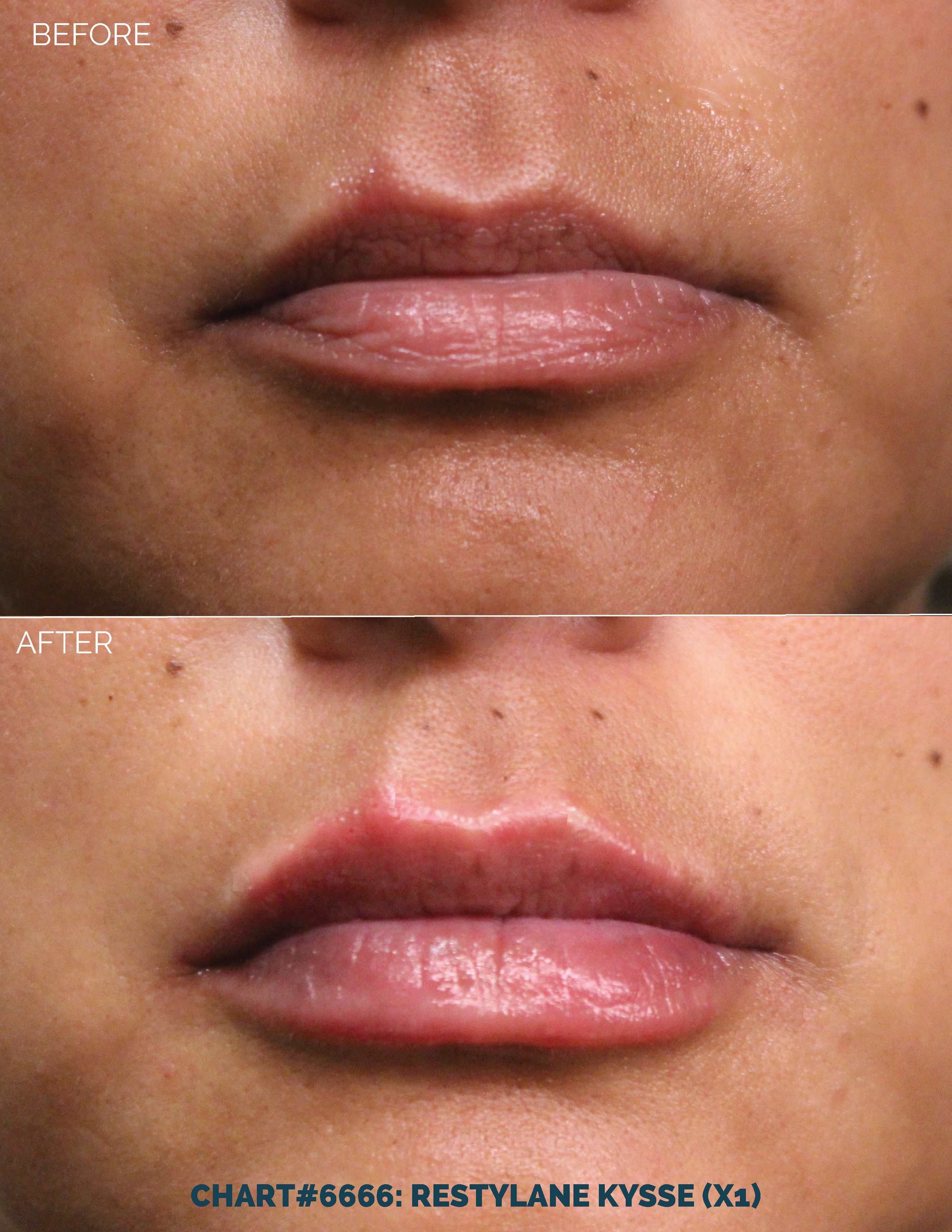 LIPS FILLER_CHART#6666- RESTYLANE KYSSE (X1).png