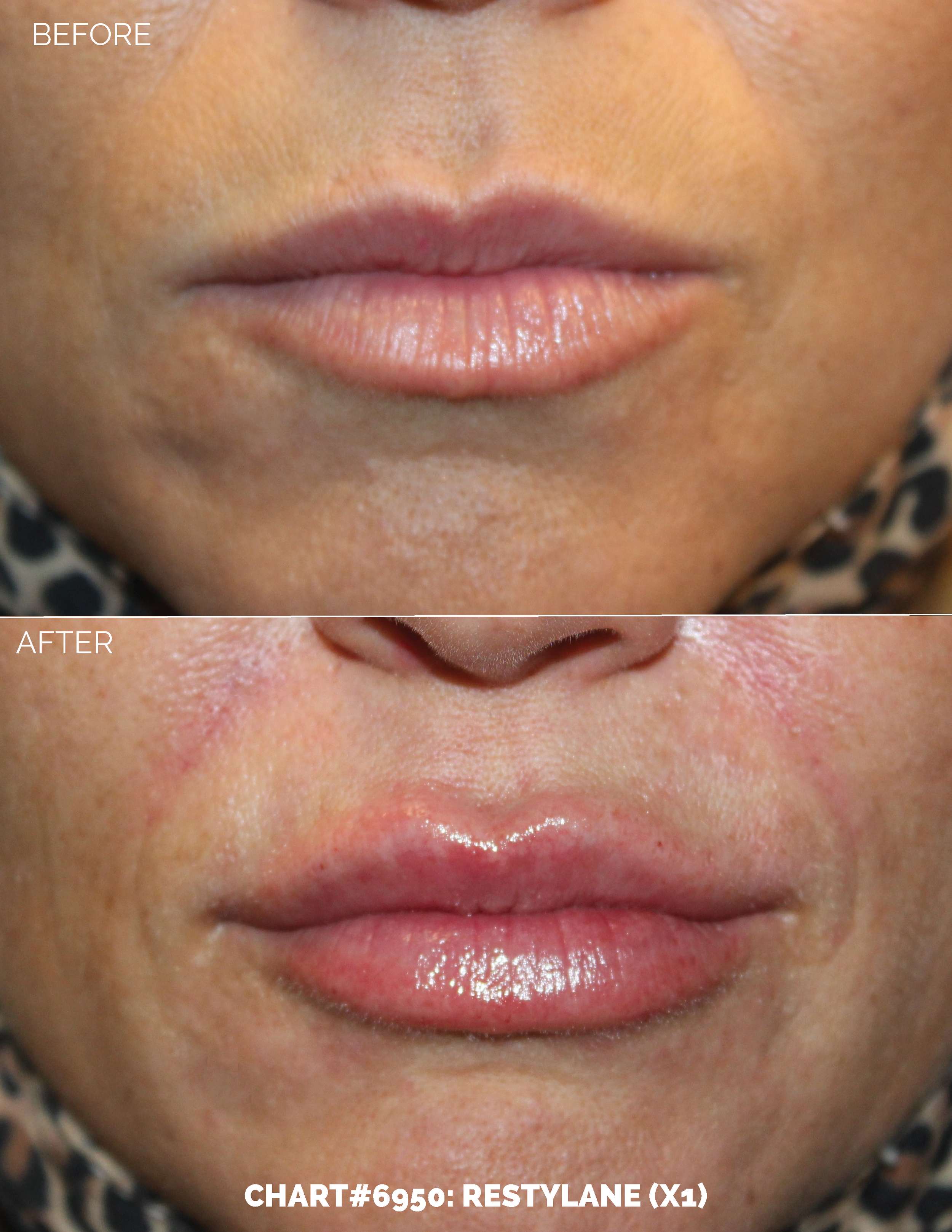 LIPS FILLER_CHART#6950- RESTYLANE (X1).png