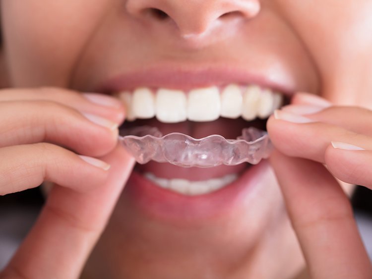 Clear aligners treatment