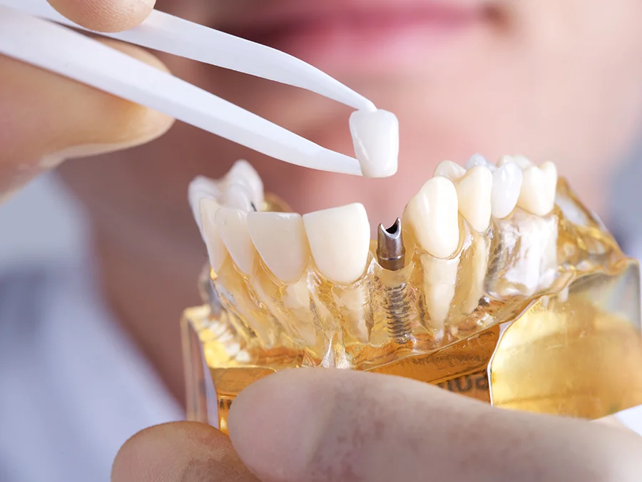 Dental implant restoratiaon