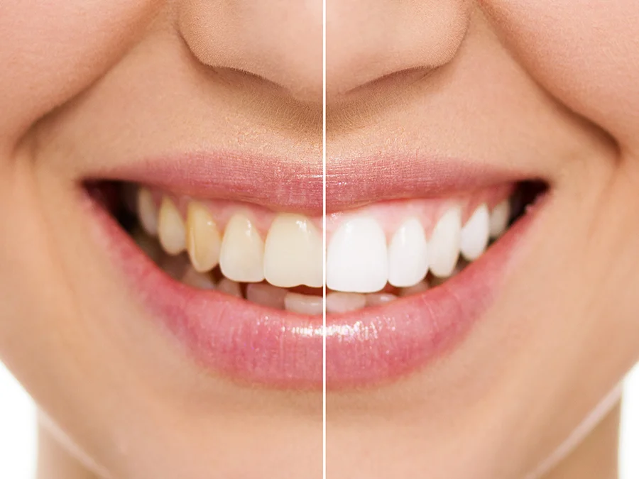 teethwhitenening_0.jpg