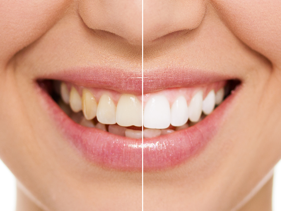 The Benefits and Risks of DIY Teeth Whitening in Okotoks