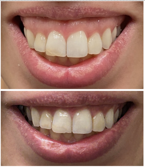 Gummy Smile Treatment