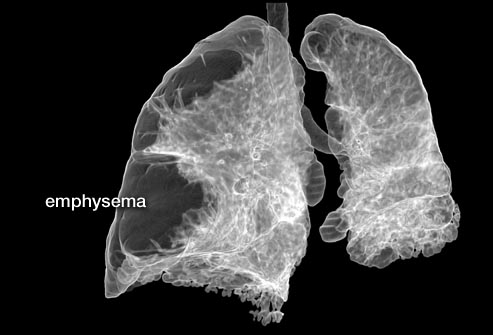 princ_rm_photo_of_scan_of_lungs.jpg