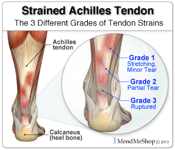achilles-tendon-3-types-of-strains.png
