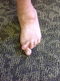 Ok, That's Nasty, it's Not my Toe!