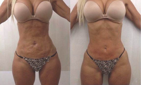 tightsculpting_abdomin.jpg