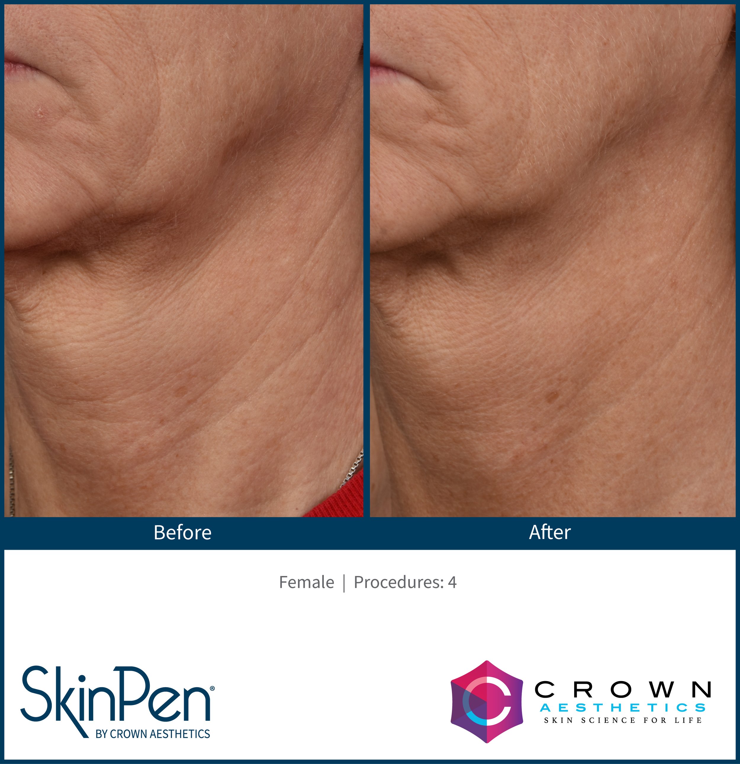 SkinPen-Before_and_After (15).jpg