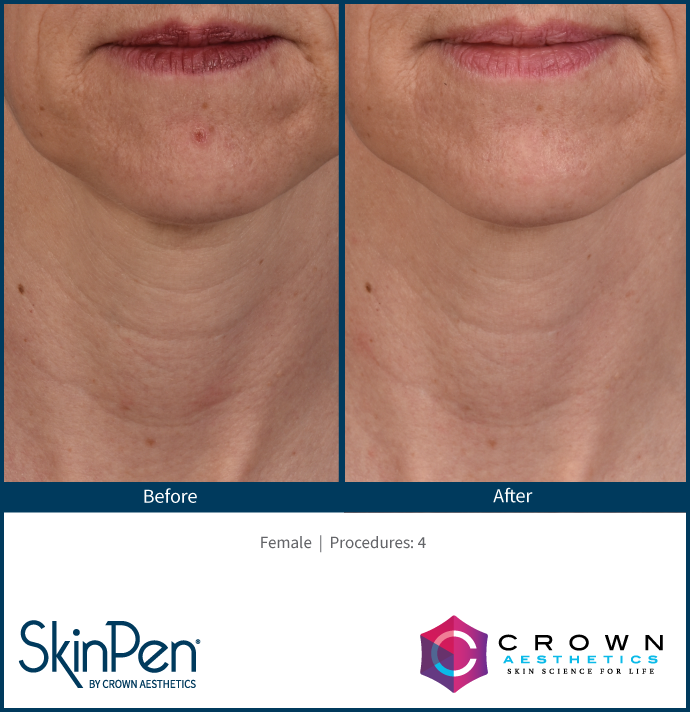 SkinPen-Before_and_After (12).png