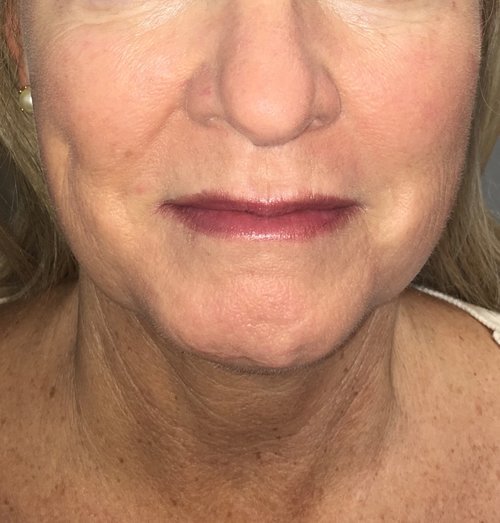 Before RF Microneedling at House of Aesthetics Med Spa in Cary.jpeg