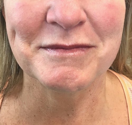 After RF Microneedling at House of Aesthetics Med Spa in Cary.jpeg