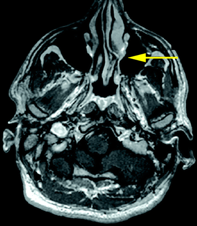 Contact Point Headache 