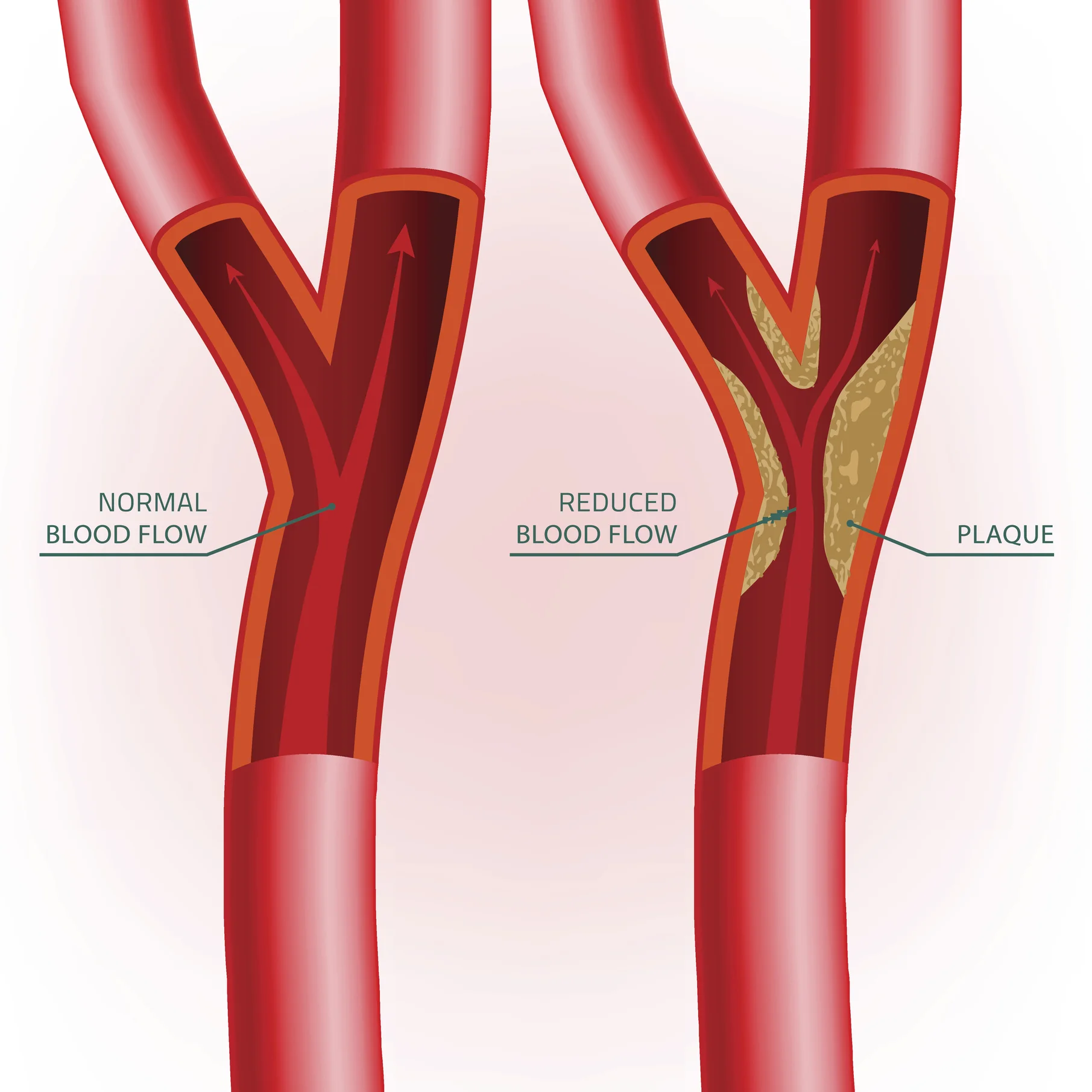 Atherosclerotic artery on right.