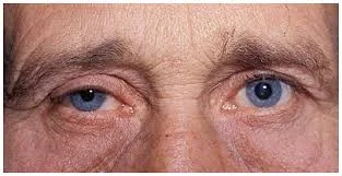 Right Horner syndrome with slight lid droop and pupillary smallness.