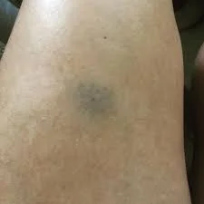 Small bruise at site of Aimovig subcutaneous injection