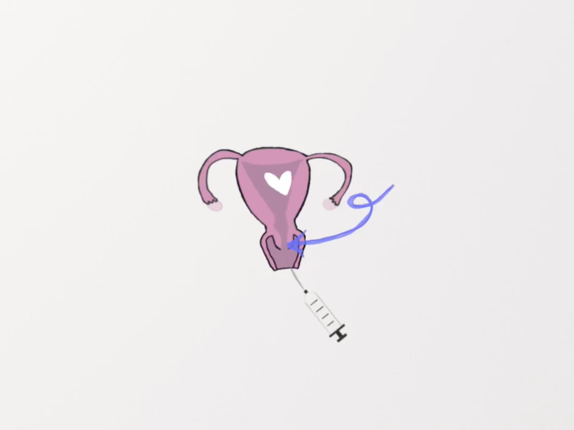 Learn What Intrauterine Insemination is from this Lovely Animation