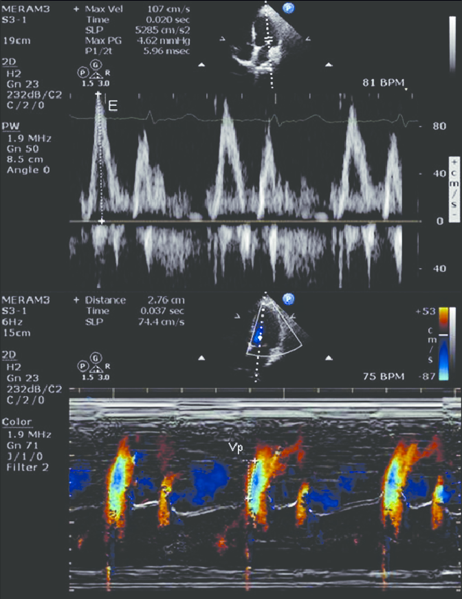 Figure-1-Measurement-of-color-M-mode-flow-propagation-velocity-and-the-EVp-ratio-EVp.png