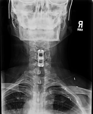 ACDF3b+mustafakhanmd.jpg