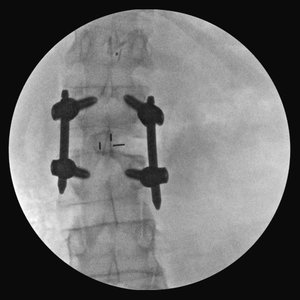 lumbar13b+mustafakhanmd.jpg