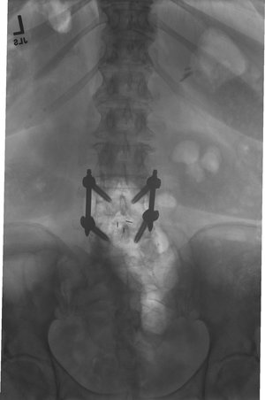 lumbar12d+mustafakhanmd.jpg