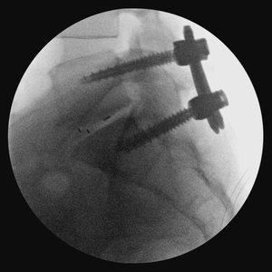 lumbar1b+mustafakhanmd.jpg