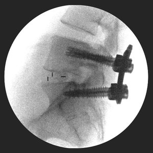 lumbar4c+mustafakhanmd.jpg