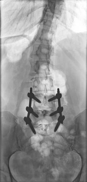 lumbar26a+mustafakhanmd.jpg