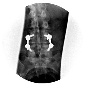 lumbar5a+mustafakhanmd.jpg