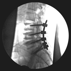 lumbar3b+mustafakhanmd.jpg